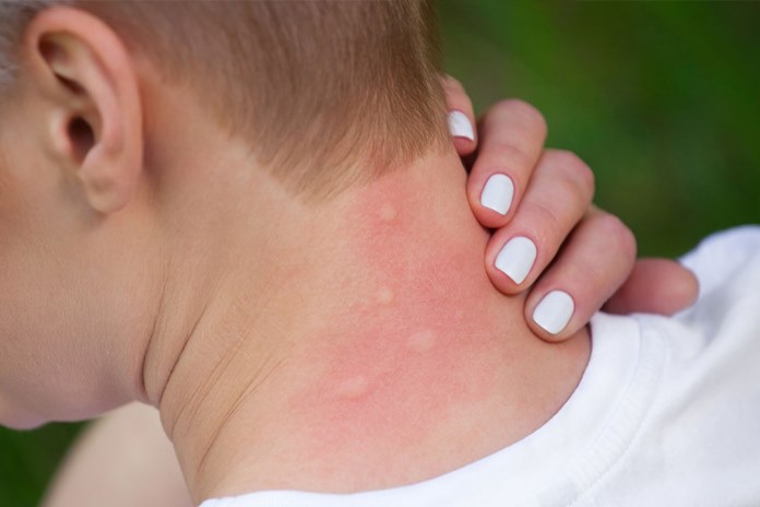 Kaip padėti sau ir aplinkiniams kenčiantis nuo alergijų?